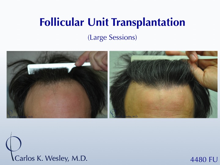 This 43-year-old man desired to reverse the progressive recession of his hairline. A total of 4480 grafts were transplanted to the frontal half of...