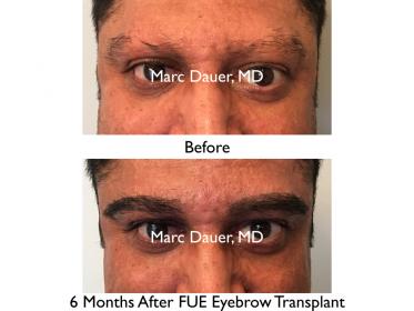 Click image for larger version

Name:	Hair Transplant Slides copy65.001.jpg

Size:	14.5 KB
ID:	47249