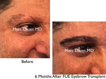 Click image for larger version

Name:	Hair Transplant Slides copy65.002.jpg

Size:	16.8 KB
ID:	47250