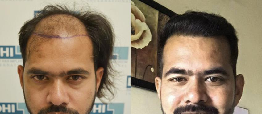 Result 5500 hair, 7 months result