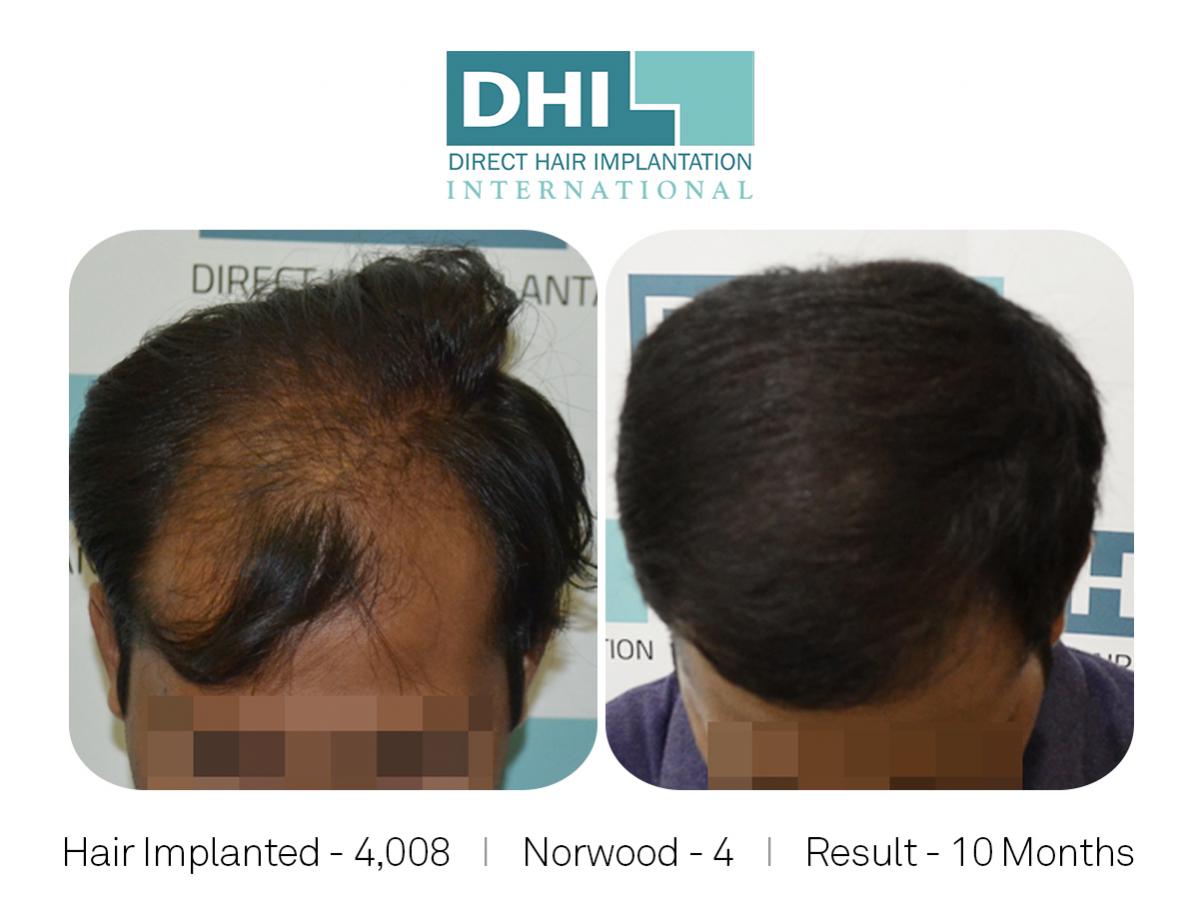 Hair Implanted - 4008, Norwood Scale - 04, 10-month results.