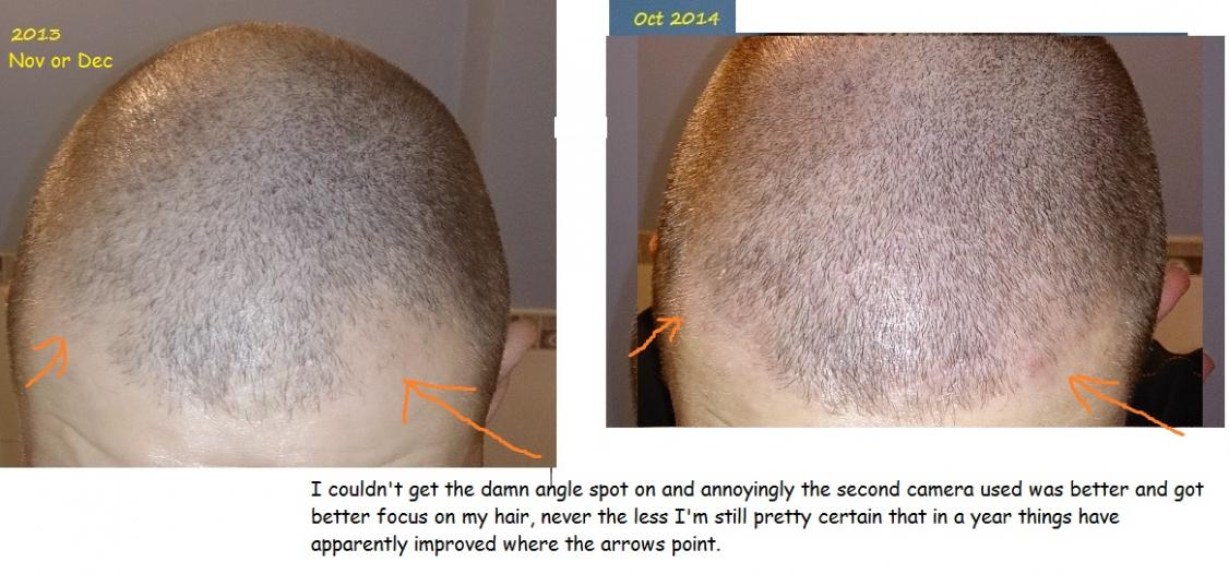 Click image for larger version

Name:	4 Hair loss Progress #2.jpg

Size:	90.3 KB
ID:	36892