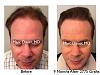 Click image for larger version

Name:	Hair Transplant Slides copy50.007.jpg

Size:	16.1 KB
ID:	46809