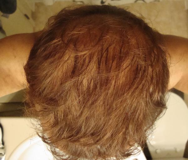 Some of the front seems ok and the hair has become a bit more curly now as it was transplanted from the back of my head.