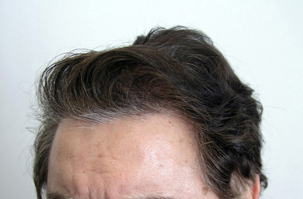 After 1 FUT:  2012 follicular units