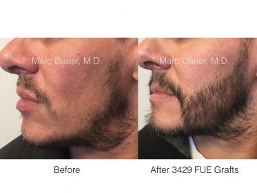 beard FUE hair transplant