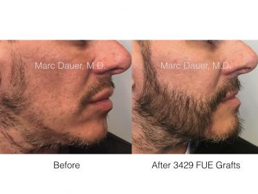 beard FUE hair transplant