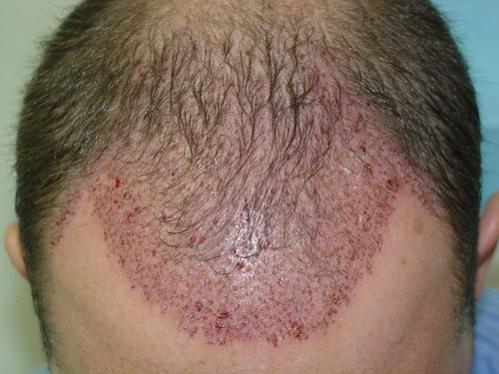 Here is the 1st surgery done on my frontal area.  1595 grafts total.