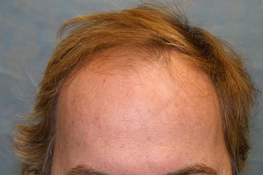 Click image for larger version

Name:	1a-hairline.jpg

Size:	22.2 KB
ID:	35817