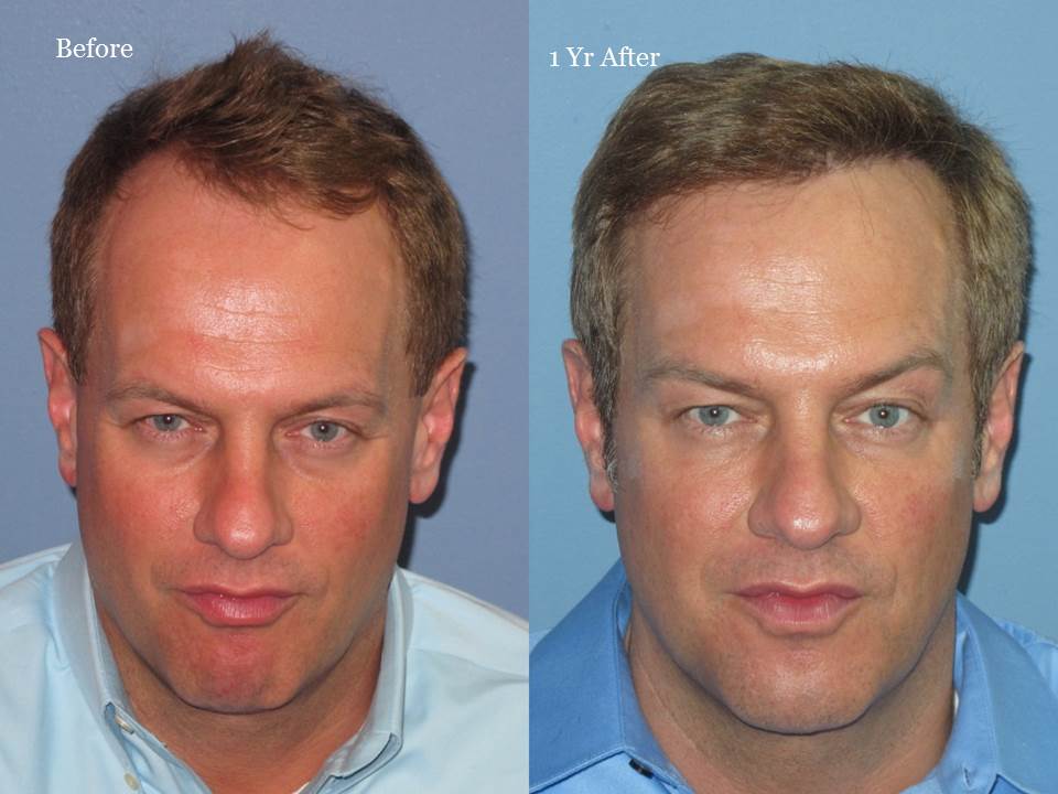 Dr. Paul Shapiro, MD  
FUT 2125 grafts 
12 months post-op