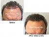 Click image for larger version

Name:	Hair Transplant Slides copy21.001.jpg

Size:	14.2 KB
ID:	44272