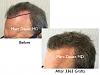Click image for larger version

Name:	Hair Transplant Slides copy21.002.jpg

Size:	14.0 KB
ID:	44273