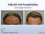 This patient is seen Before/After a 2391 graft 
session with Carlos K. Wesley, M.D. 
 
An interactive Before/After image of this patient can be...