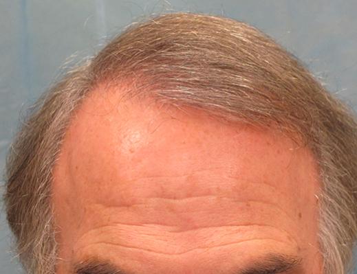 Click image for larger version

Name:	05-after-hairline.jpg

Size:	27.6 KB
ID:	33117