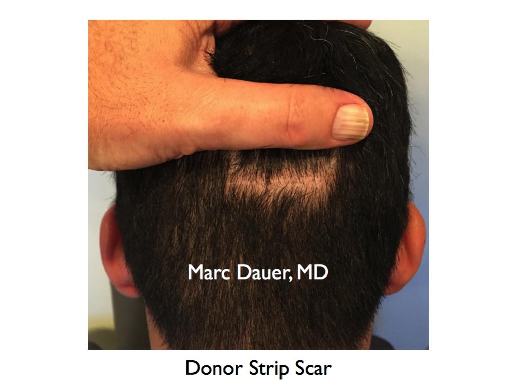 Click image for larger version

Name:	Hair Transplant Slides.754.jpg

Size:	61.7 KB
ID:	41762