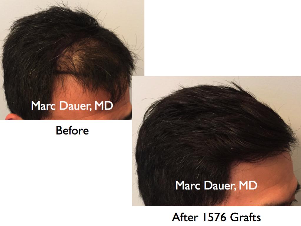 Click image for larger version

Name:	Hair Transplant Slides.752.jpg

Size:	62.4 KB
ID:	41760