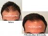 Click image for larger version

Name:	Hair Transplant Slides copy63.001.jpg

Size:	13.1 KB
ID:	47136