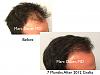 Click image for larger version

Name:	Hair Transplant Slides copy63.003.jpg

Size:	12.8 KB
ID:	47137