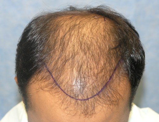 Click image for larger version

Name:	07_position-of-hairline-top.jpg

Size:	68.3 KB
ID:	6541