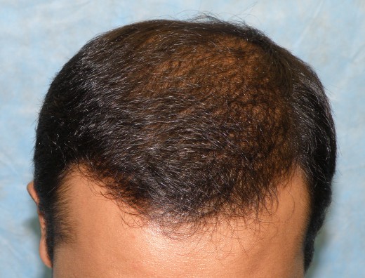 Click image for larger version

Name:	08_after-first-hair-transplant-top.jpg

Size:	70.6 KB
ID:	6542