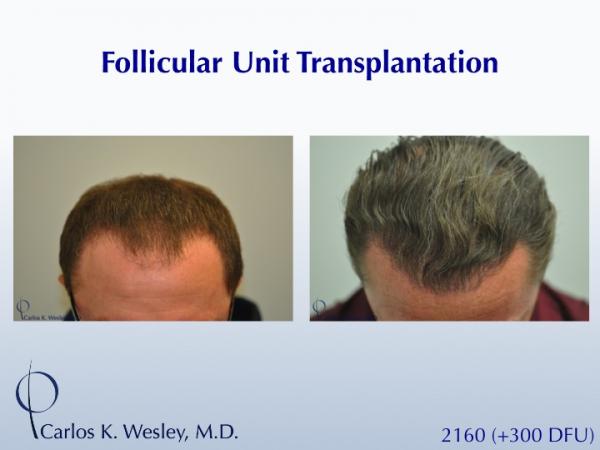 This 40-year old underwent surgical hair restoration with Dr. Carlos K. Wesley (NYC).  He received 2460 grafts (300 of which were DFUs) and presented...