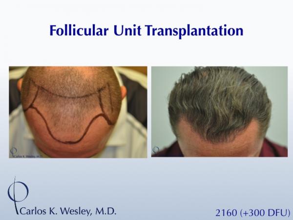 This 40-year old underwent surgical hair restoration with Dr. Carlos K. Wesley (NYC).  He received 2460 grafts (300 of which were DFUs) and presented...