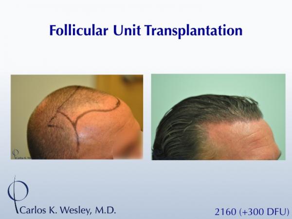 This 40-year old underwent surgical hair restoration with Dr. Carlos K. Wesley (NYC).  He received 2460 grafts (300 of which were DFUs) and presented...