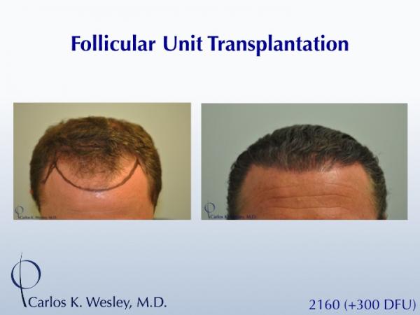 This 40-year old underwent surgical hair restoration with Dr. Carlos K. Wesley (NYC).  He received 2460 grafts (300 of which were DFUs) and presented...