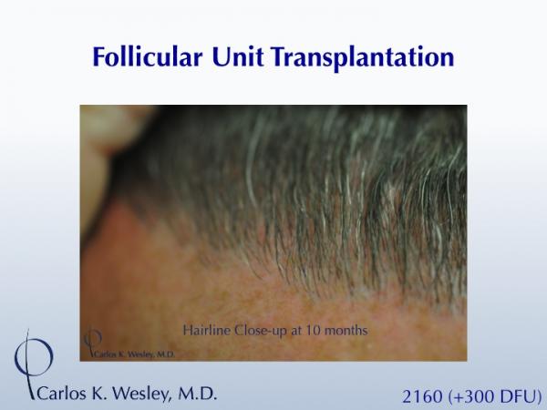 This 40-year old underwent surgical hair restoration with Dr. Carlos K. Wesley (NYC).  He received 2460 grafts (300 of which were DFUs) and presented...