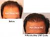 Click image for larger version

Name:	Hair Transplant Slides1.282.jpg

Size:	65.1 KB
ID:	35228