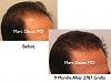 Click image for larger version

Name:	Hair Transplant Slides1.284.jpg

Size:	60.5 KB
ID:	35229