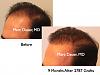 Click image for larger version

Name:	Hair Transplant Slides1.283.jpg

Size:	59.5 KB
ID:	35230