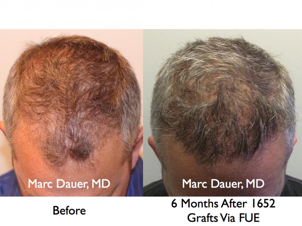 Click image for larger version

Name:	Hair Transplant Slides9.260.jpg

Size:	93.1 KB
ID:	34779