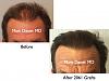 Click image for larger version

Name:	Hair Transplant Slides.646.jpg

Size:	66.5 KB
ID:	40184