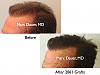 Click image for larger version

Name:	Hair Transplant Slides.647.jpg

Size:	60.8 KB
ID:	40185