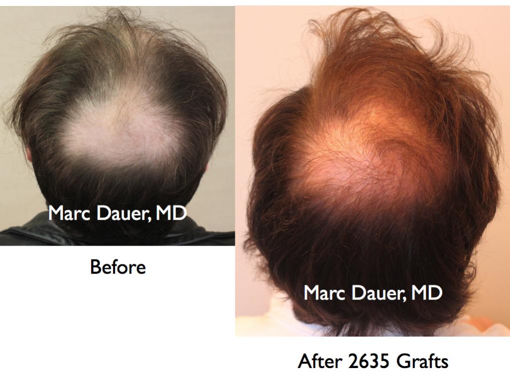 Click image for larger version

Name:	Hair Transplant Slides3.153.jpg

Size:	78.9 KB
ID:	25941