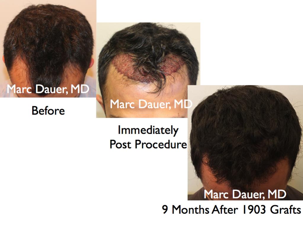 Click image for larger version

Name:	Hair Transplant Slides5.323.jpg

Size:	70.8 KB
ID:	35802