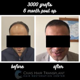 Procedure: FUE Hair Transplant 
Number of grafts: 3000 Grafts 
Results: 6 Months Post-op