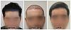 Click image for larger version

Name:	Hairline-6Months-Forum (1) copy.jpg

Size:	93.7 KB
ID:	72814