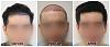 Click image for larger version

Name:	Hairline-Clinic-Forums copy.jpg

Size:	90.4 KB
ID:	72816