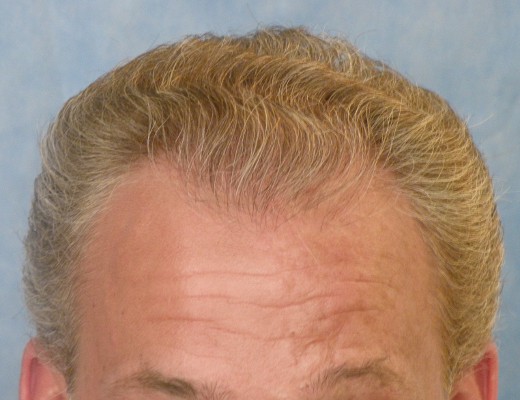 Click image for larger version

Name:	05_after-1st-hair-transplant.jpg

Size:	53.3 KB
ID:	7532