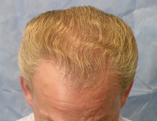 Click image for larger version

Name:	07_after-1st-hair-transplant-top-view.jpg

Size:	61.4 KB
ID:	7534