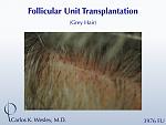 The patient's resultant donor scar after 3976 grafts via FUT with Dr. Carlos K. Wesley 
 
A video of this patient's transformation may be viewed...
