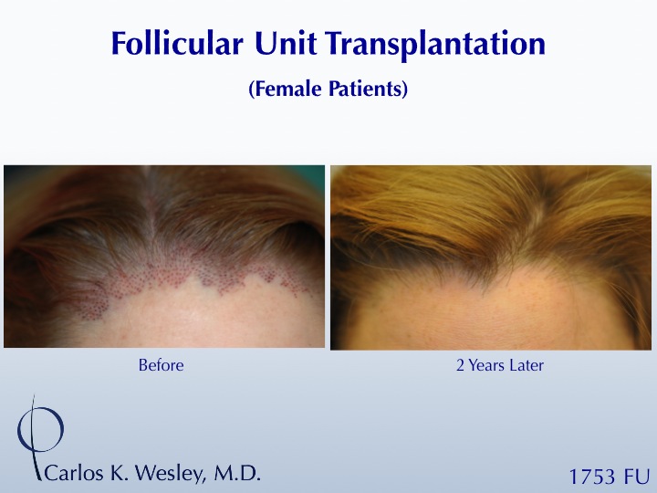 This 32-year-old woman benefitted from FUT with Dr. Carlos K. Wesley (NYC).
