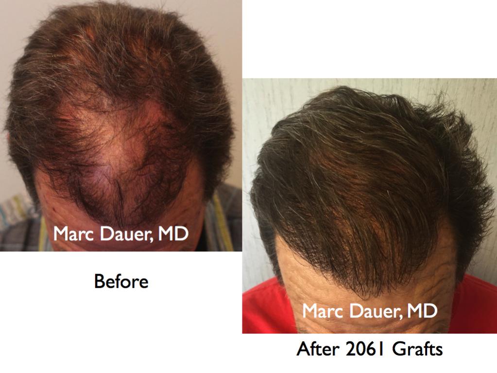 Click image for larger version

Name:	Hair Transplant Slides.649.jpg

Size:	81.5 KB
ID:	40187