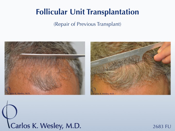 This patient presented to Dr. Carlos K. Wesley (NYC) after having undergone a hair transplant session at a different NYC surgical office.  His...