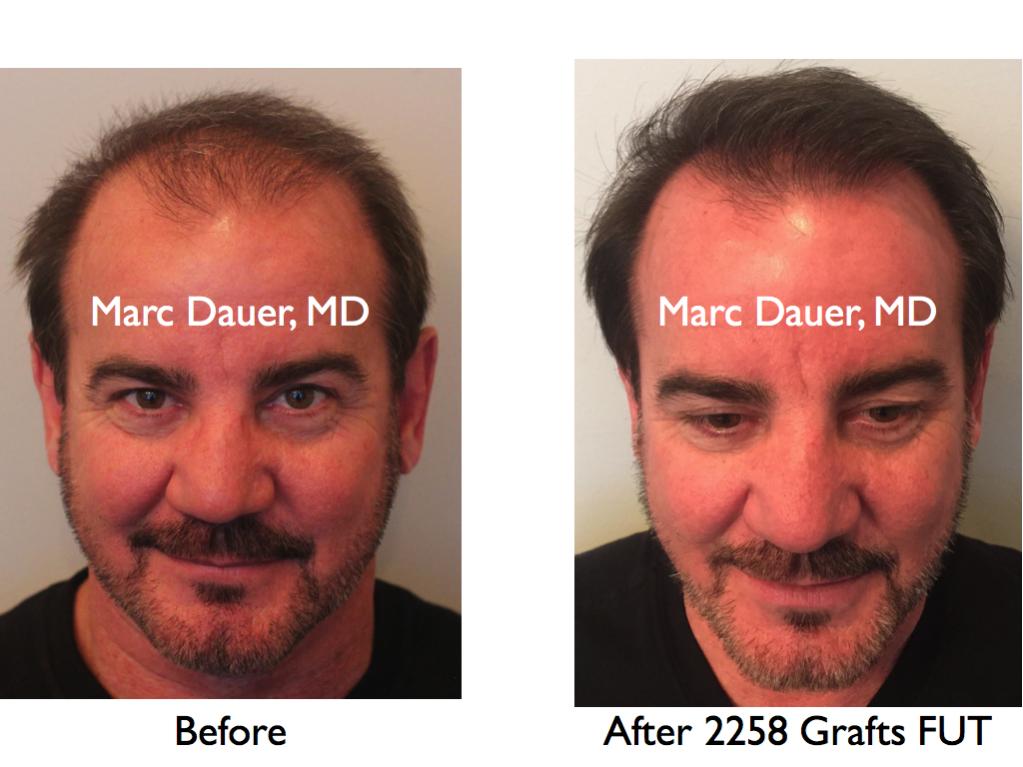 Click image for larger version

Name:	Hair Transplant Slides.667.jpg

Size:	74.6 KB
ID:	40757