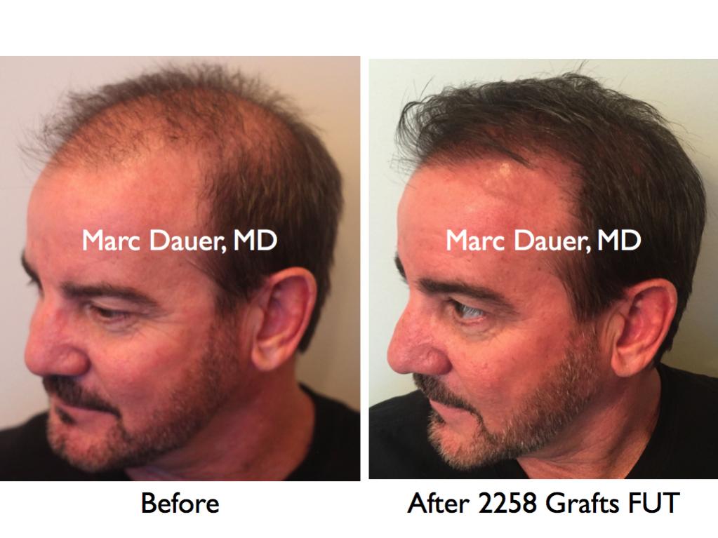 Click image for larger version

Name:	Hair Transplant Slides.668.jpg

Size:	71.1 KB
ID:	40758