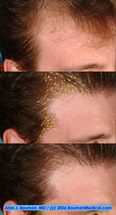 Click image for larger version

Name:	hairline_temp-point_plan.jpg

Size:	72.9 KB
ID:	865