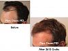 Click image for larger version

Name:	Hair Transplant Slides5.038.jpg

Size:	59.9 KB
ID:	23658